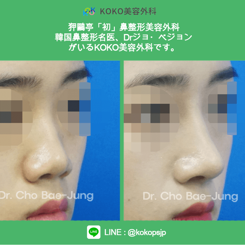 KOKO美容外科の症例写真１