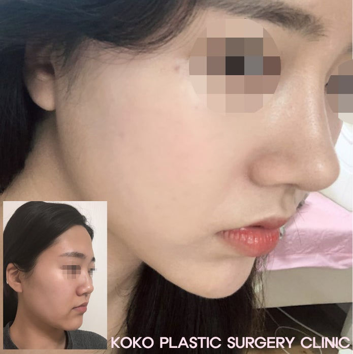 鼻手術&再手術専門のKOKO美容外科-韓国鼻の手術 悩むのはもうやめましょう | 鼻手術-韓国鼻の手術-KOKO美容外科 | 韓国鼻整形専門美容外科