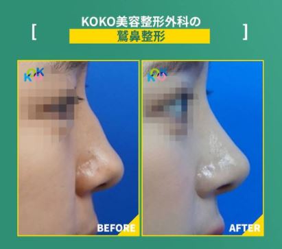 韓国鼻整形専門病院KOKO美容外科-鷲鼻矯正手術の方法と症例 | KOKO美容外科 | 韓国鼻整形専門美容外科 -韓国鼻整形-専門病院-鷲鼻-鼻手術