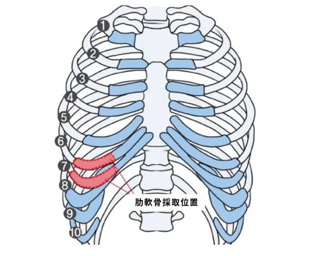 韓国鼻手術&再手術専門のKOKO美容外科-自家肋軟骨鼻先手術 | KOKO美容外科 | 韓国鼻整形専門美容外科 鼻手術 - 鼻整形 -副作用