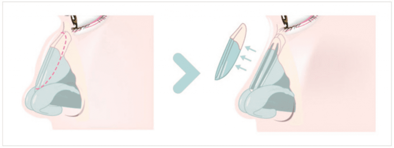 KOKO美容外科でのわし鼻の鼻整形での手術の仕方を簡単に表した画像