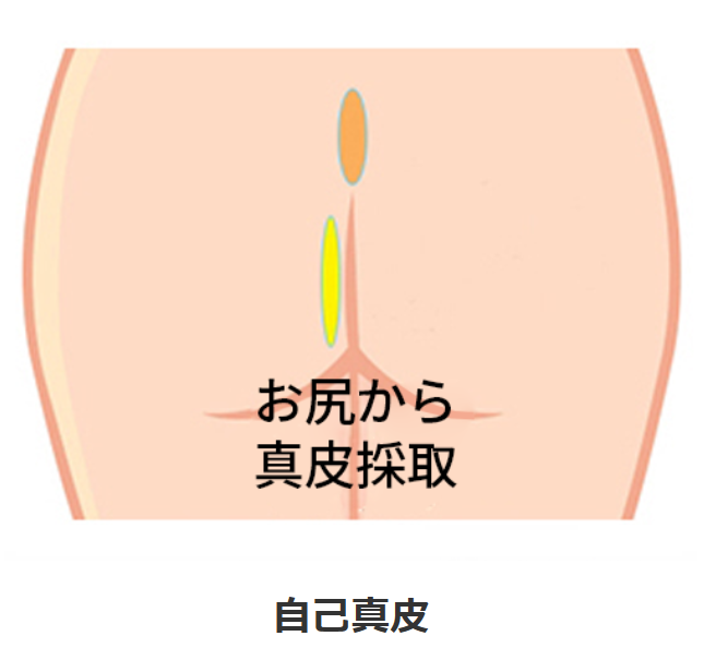 KOKO美容外科での自家組織での鼻整形の際に使われる安全な真皮