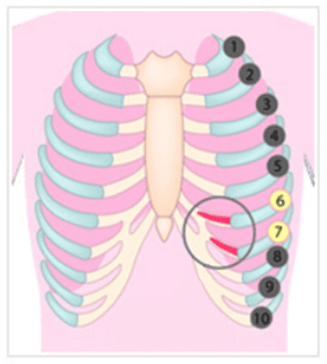 KOKO美容外科での自家肋軟骨を使用した鼻整形での肋軟骨の場所の画像
