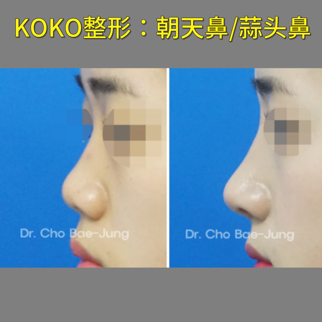 韩国KOKO整形医院成功案例——改善 “猪鼻”，展现新面貌 | KOKO美容外科 想要拥有一部精致立体的鼻形吗？ 韩国