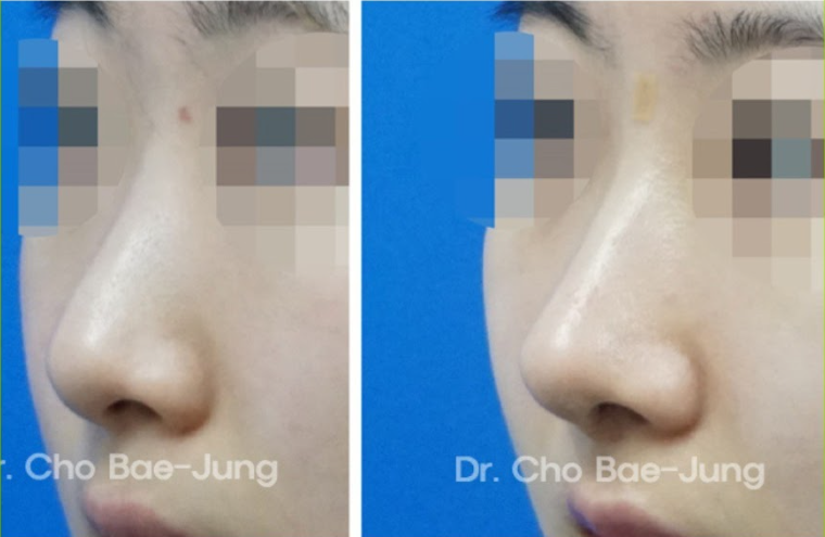 KOKO美容外科の特別な鼻尖形成 | Korea's Top Nose Revision Specialist