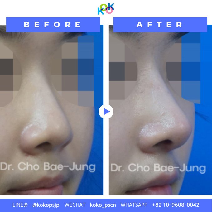 韓国KOKO美容外科の団子鼻矯正術で理想の美鼻を実現!
