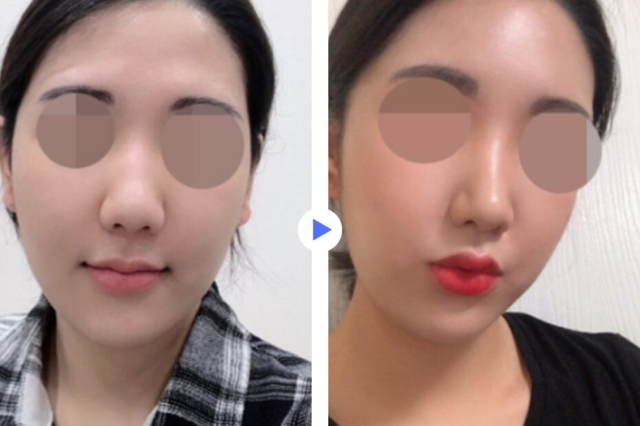 「鼻整形の症例紹介|KOKO美容外科:ココで理想の鼻を手に入れましょう」 このテキストには、「鼻整形」「ココ美容外科」のキーワードを含め、内容に合った説明が含まれています。