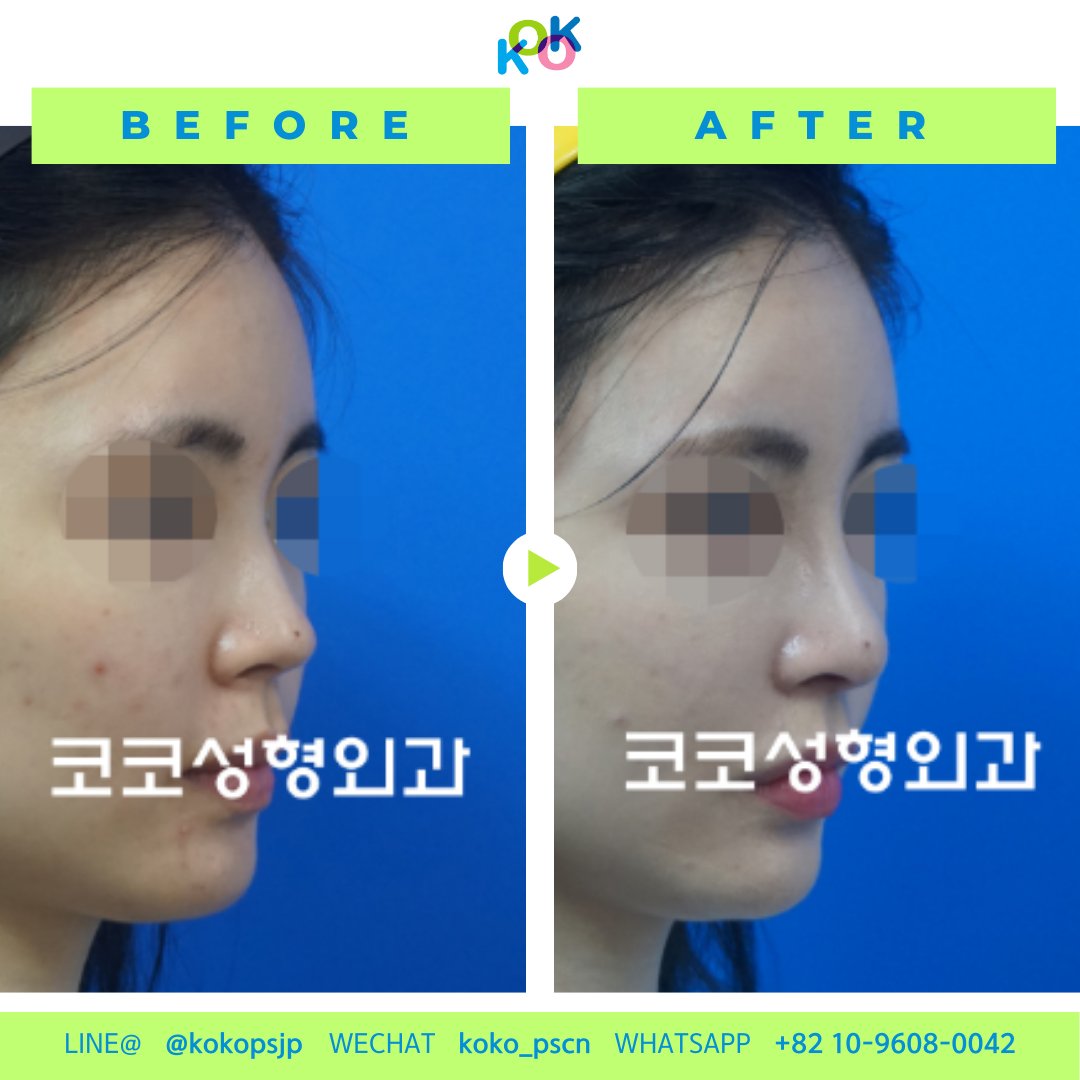韓国KOKO美容外科で理想の鼻に!高く幅のある鼻筋を実現する専門クリニック