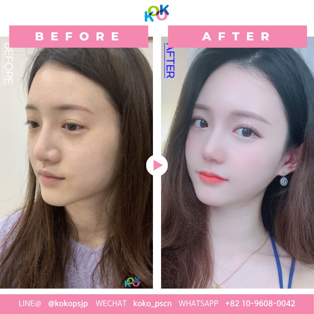 韓国KOKO美容外科で理想の小顔に!団子鼻矯正と頬骨縮小