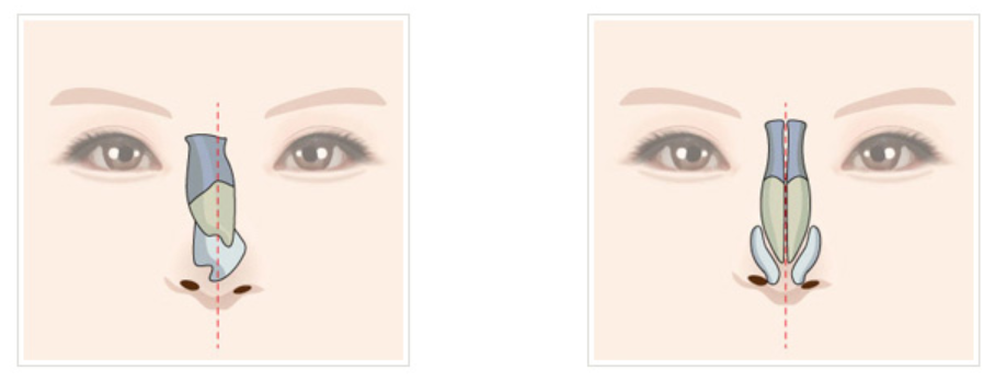 [KOKO美容外科] 曲がった鼻矯正 | Korea's Top Nose Revision Specialist