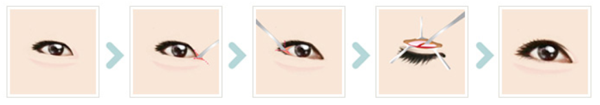 | Korea's Top Nose Revision Specialist