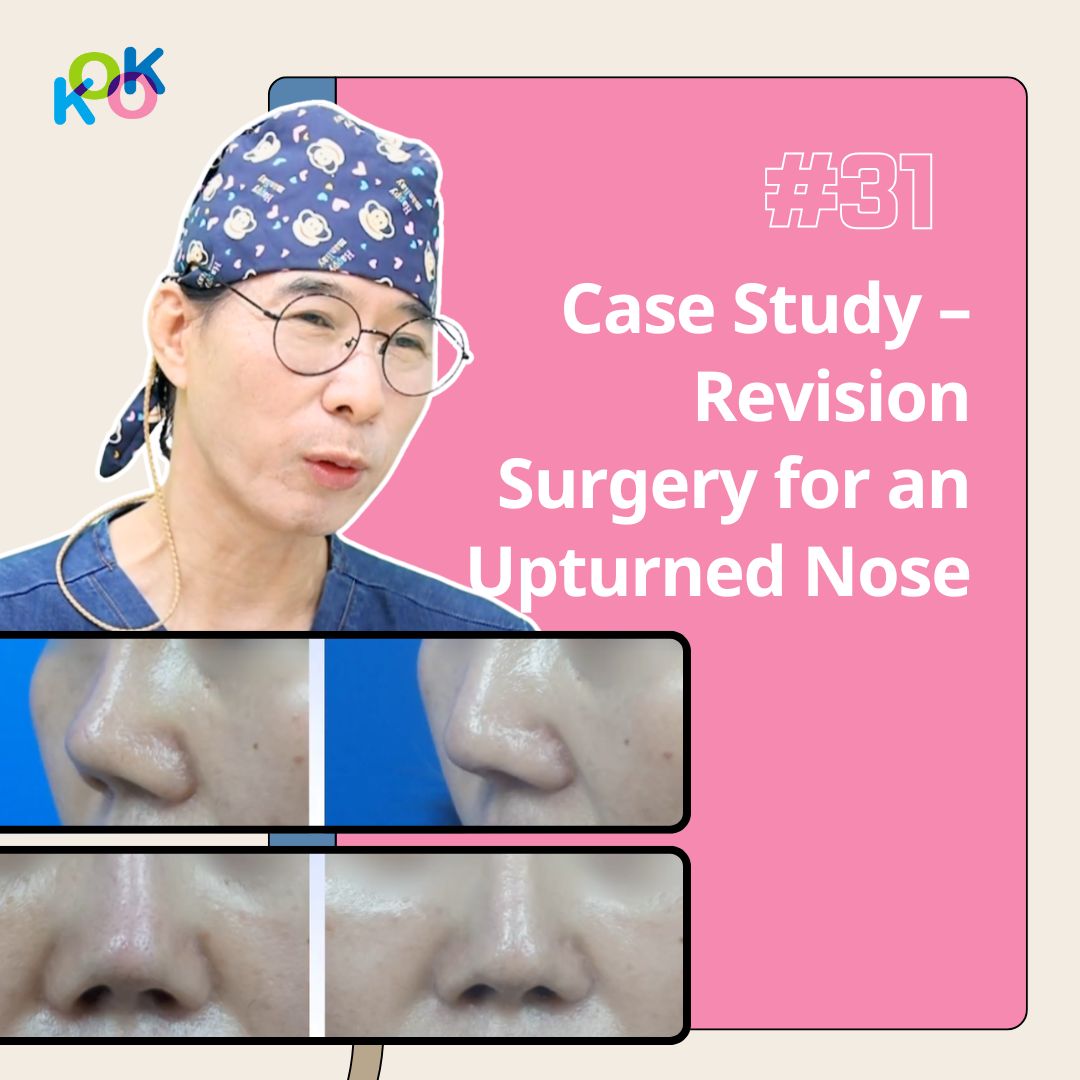 Upturned Nose Revision with Rib Cartilage Case Study