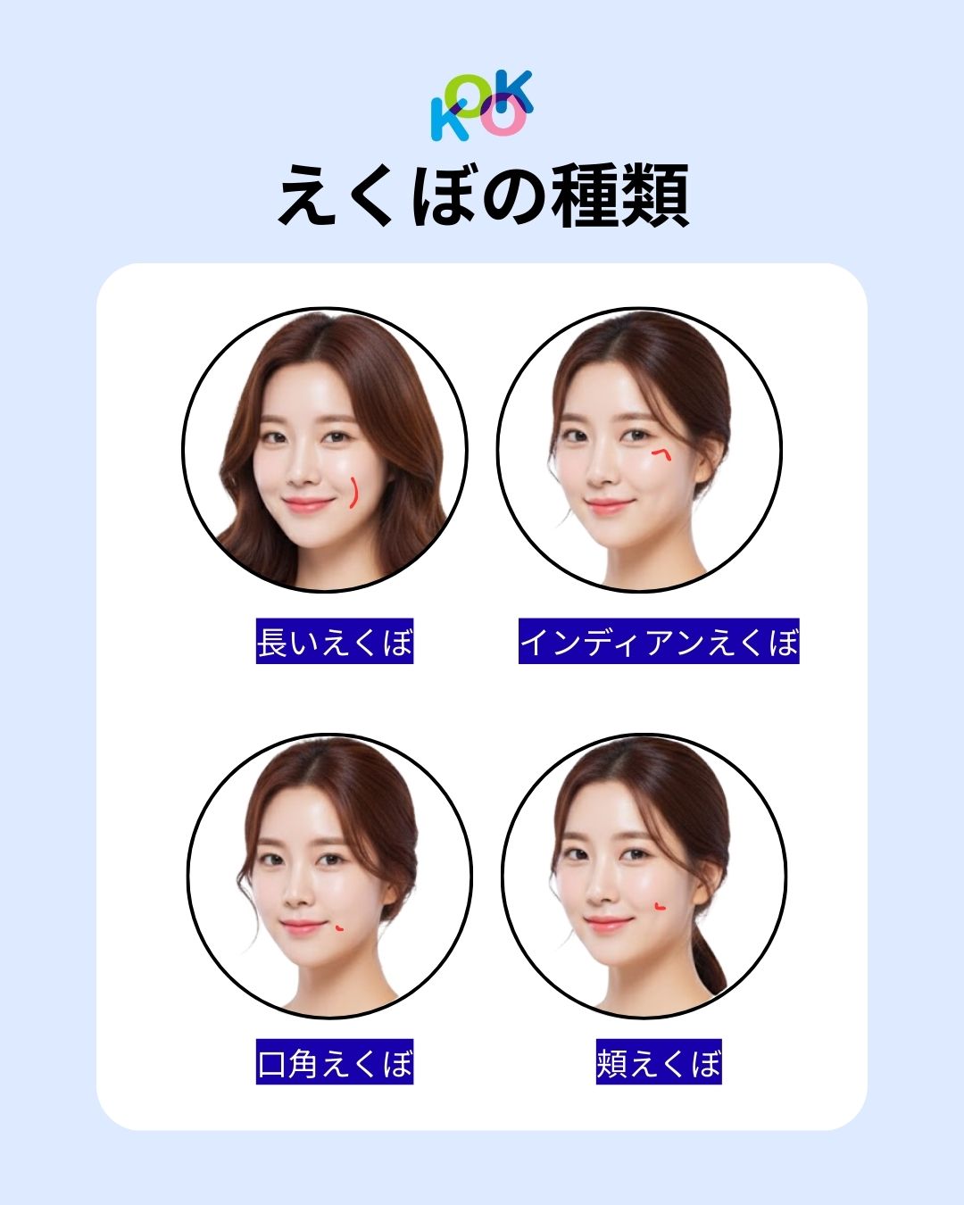えくぼの種類4つのタイプ別に紹介する比較画像。韓国式の自然な仕上がりをイメージしたイラストで、「長いえくぼ」「インディアンえくぼ」「口角えくぼ」「頬えくぼ」のそれぞれの位置が赤い線で分かりやすく示されています。