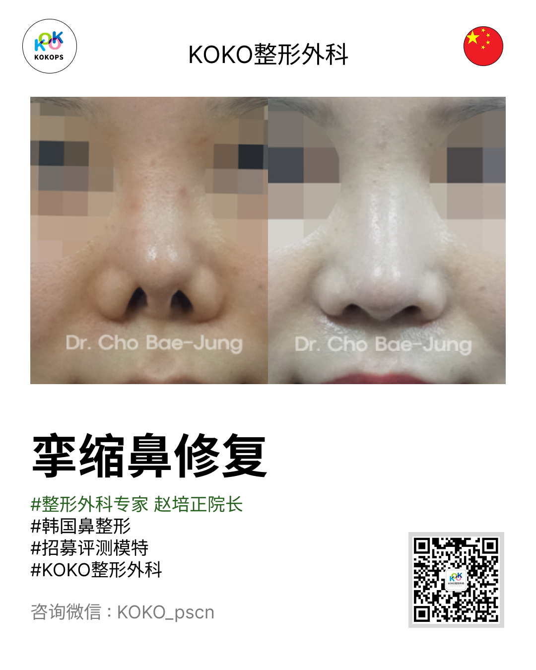 KO整形外科赵培正院长（Dr. Cho Bae-Jung）执刀的挛缩鼻修复手术前后对比照片（Before & After）。左侧为术前挛缩鼻形态，右侧为术后修复形态，展示了鼻孔和鼻尖的改善效果。图片包含“挛缩鼻修复”大字标题、热门标签及咨询二维码。