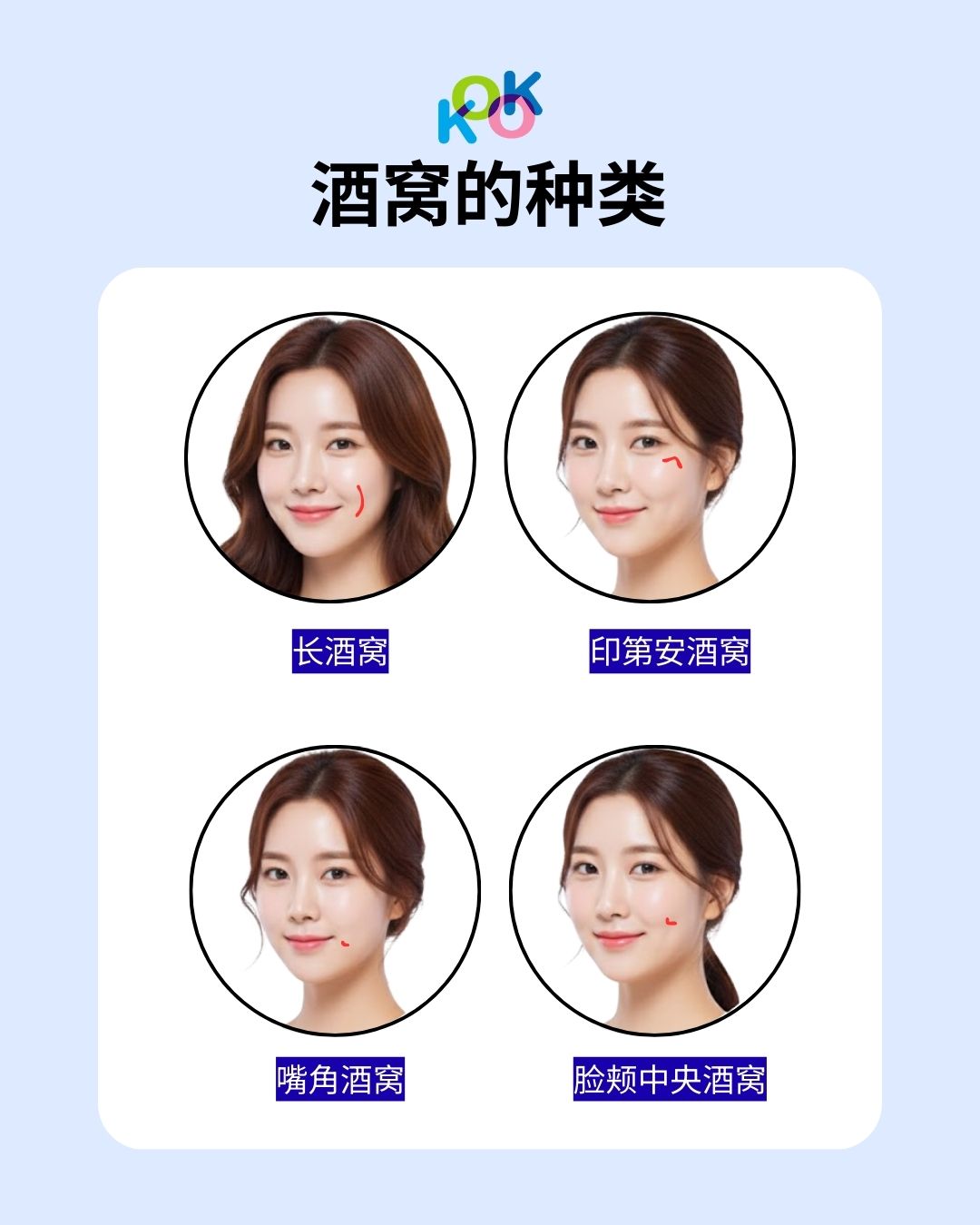这张图片详细介绍了韩国整形中常见的四种酒窝种类：  长酒窝：垂直延伸，更显温柔。  印第安酒窝：位于颧骨上方，给人俏皮可爱的感觉。  嘴角酒窝：位于嘴角边，娇小可爱。  脸颊中央酒窝：最经典的位置，增添甜美感。 通过对比图，帮助顾客选择最符合自己气质的酒窝设计。