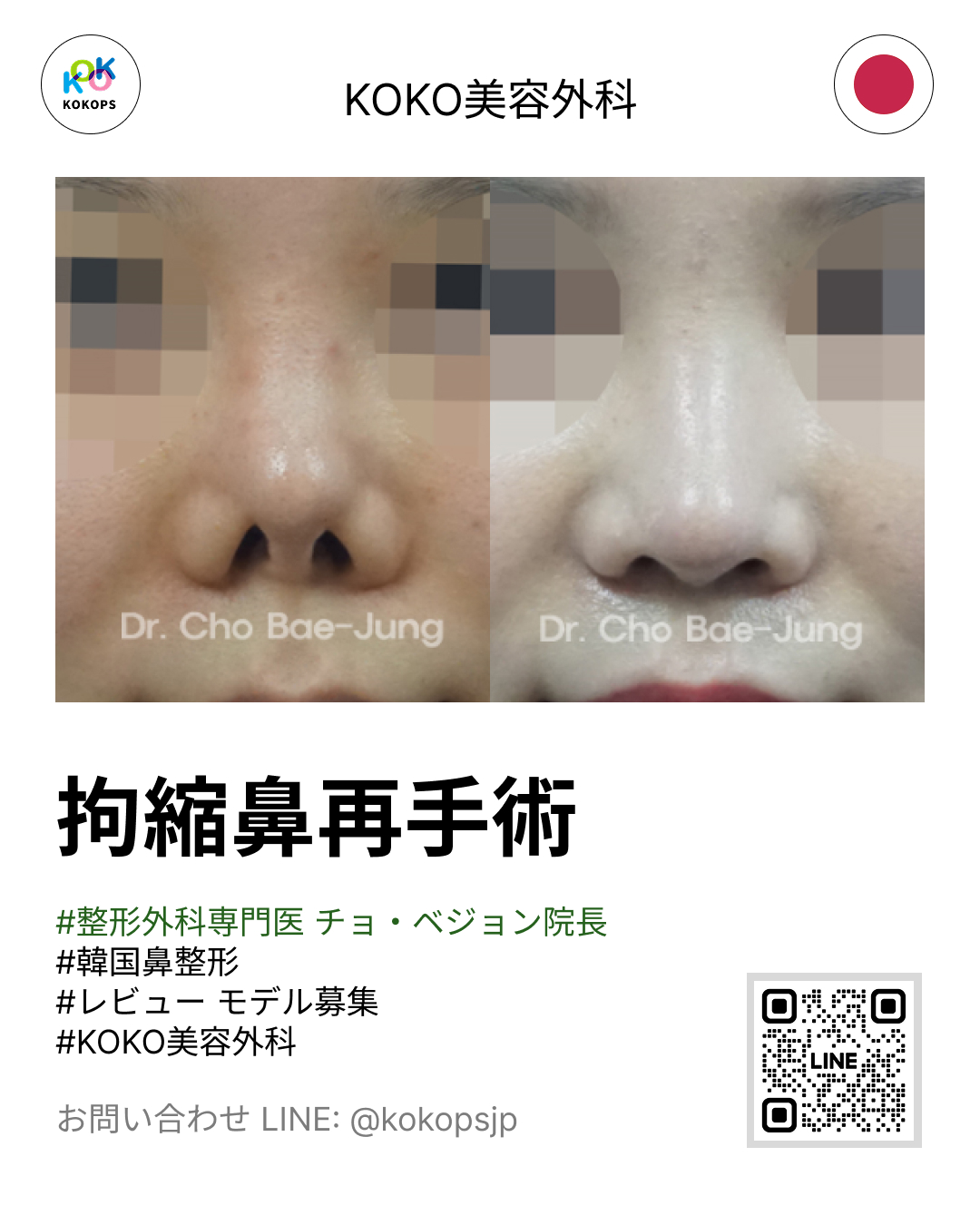 KOKO美容外科のチョ・ベジョン院長による拘縮鼻再手術(こうしゅくばな)の症例写真。手術前後の変化を確認できるビフォーアフター画像です。整形外科専門医が執刀する信頼できる韓国鼻整形。お問い合わせは画像のLINE QRコードまたはID(@kokopsjp)から可能です。