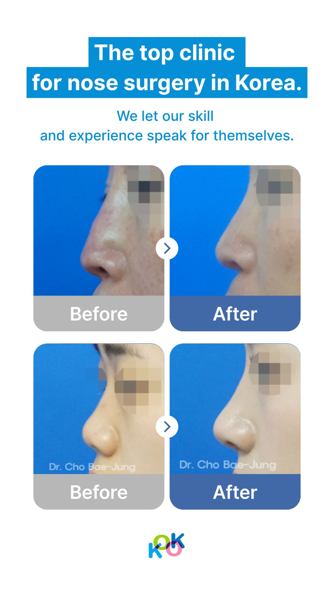 A clinical showcase titled "The top clinic for nose surgery in Korea". The image displays two sets of before-and-after side profiles of patients who underwent rhinoplasty. The "After" photos show refined nose bridges and more defined nasal tips. Each photo is watermarked with "Dr. Cho Bae-Jung" and the KOK clinic logo is at the bottom.