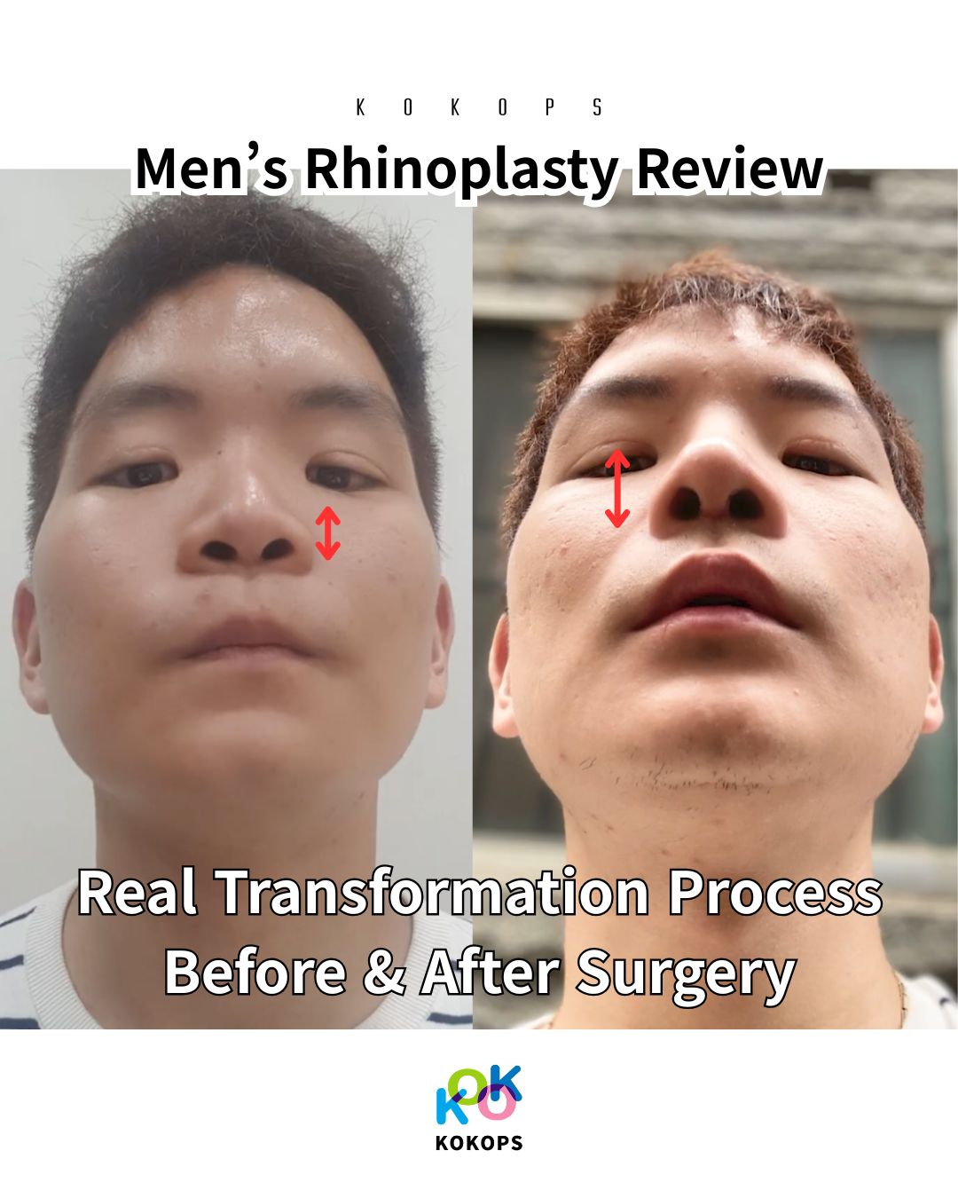 Men’s Rhinoplasty Review: Fixing Low & Upturned Nose in Korea