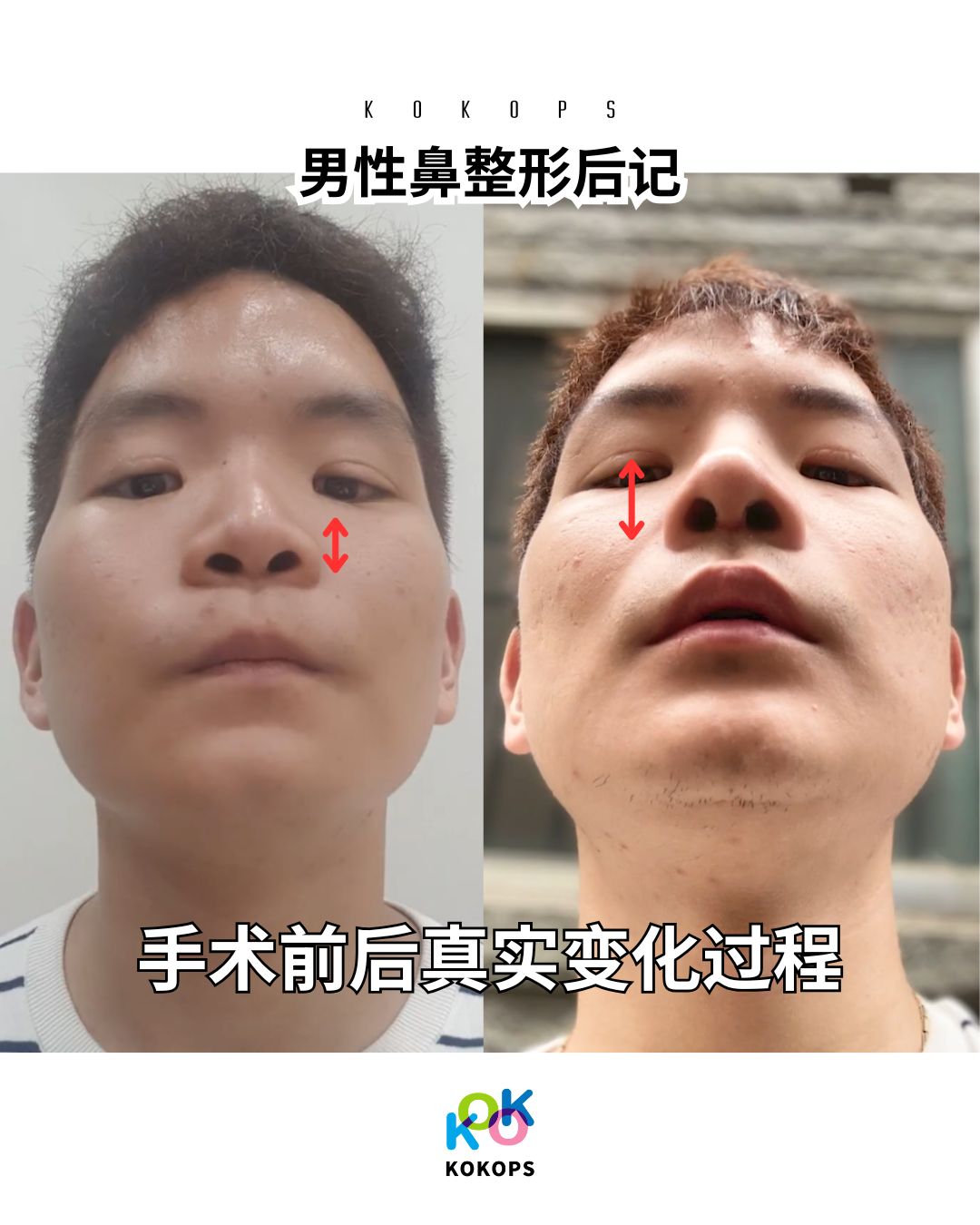 男性隆鼻手术真实案例|改善低鼻梁与朝天鼻|韩国KOKO整形外科 | 男性隆鼻