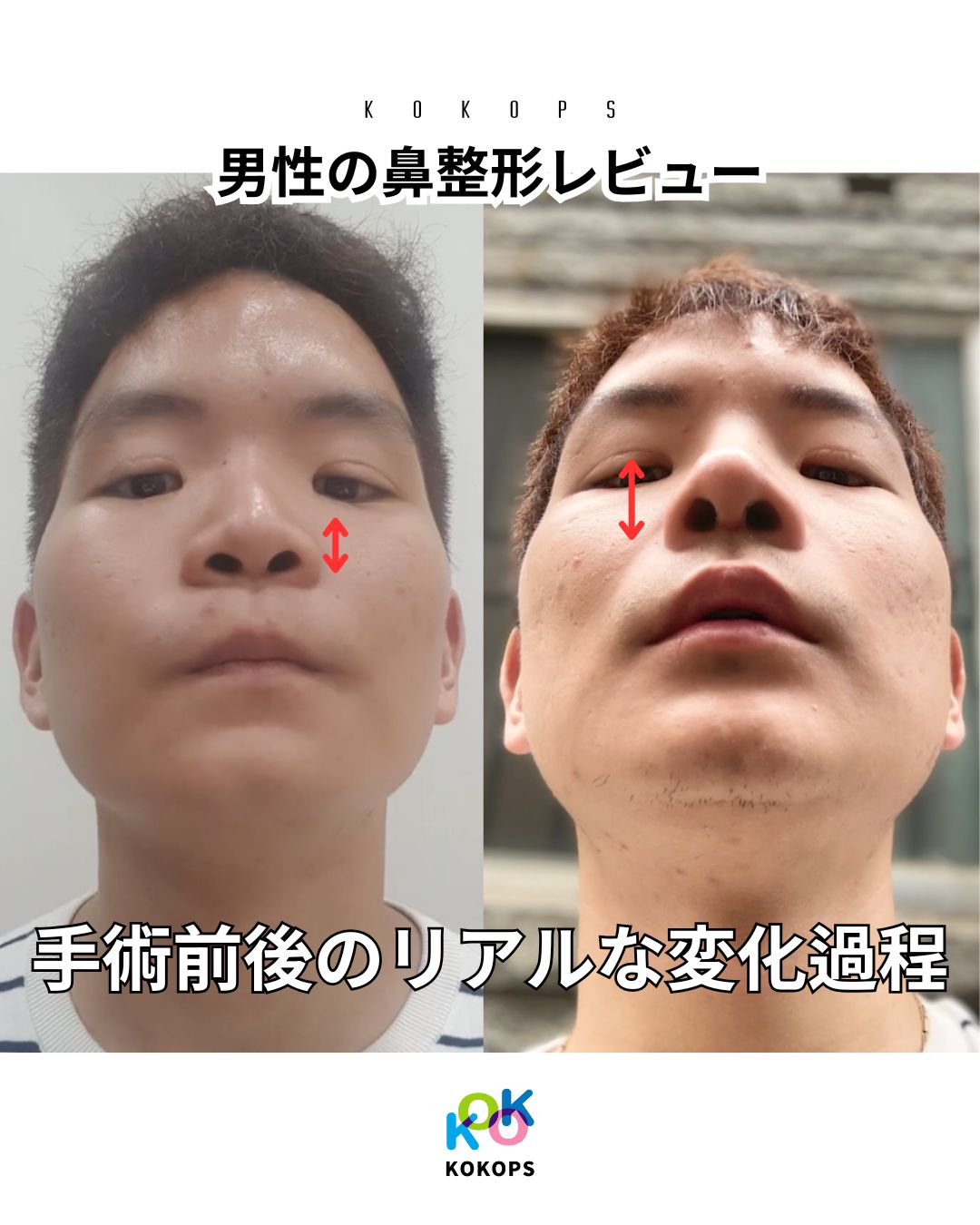 【男性の鼻整形レビュー】低い鼻・アップノーズ改善で印象激変|KOKO美容外科