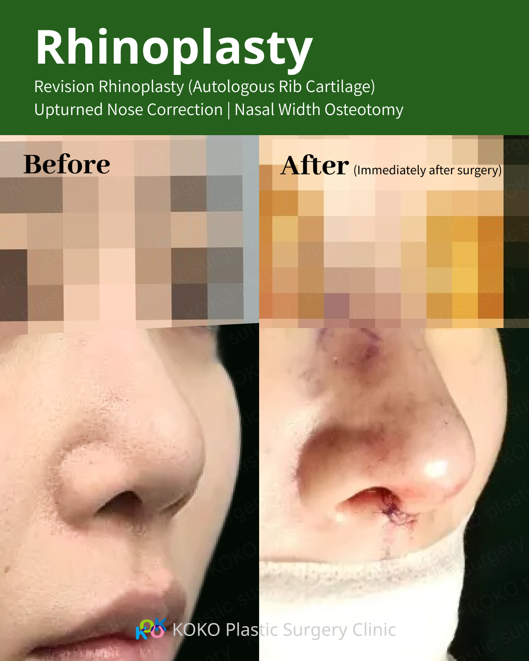 A before-and-after side-by-side comparison of a revision rhinoplasty case. The "Before" image highlights an upturned nose (short nose) deformity. The "After" image demonstrates the results of upturned nose correction and nasal width osteotomy, showing a more defined nasal bridge and a refined, lowered tip that improves the overall facial harmony.