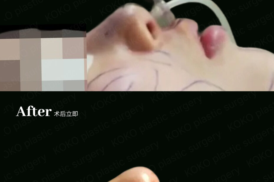 鼻修复手术对比图。上方“Before”照片显示患者躺在手术台上,鼻尖短缩且鼻孔上翻(朝天鼻)。下方“After”照片为术后立即拍摄,显示通过自体肋软骨修复后,鼻梁延长,鼻尖挺拔且下移,改善了鼻孔外露问题。