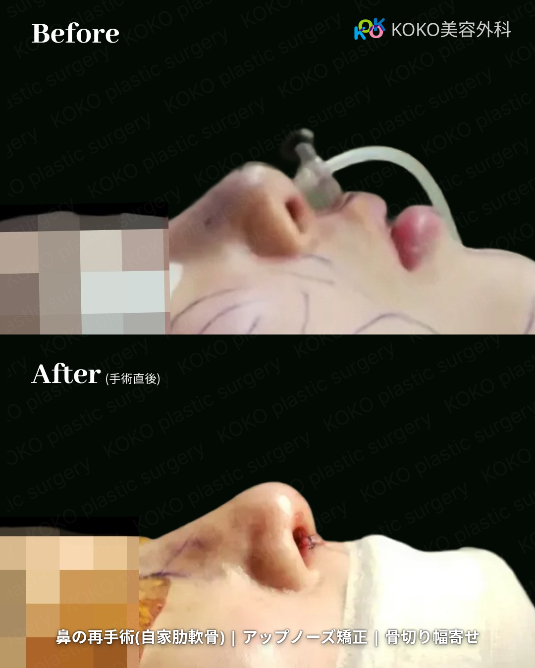 韓国で 鼻の再手術 なら?自家肋軟骨×アップノーズ矯正|KOKO美容外科