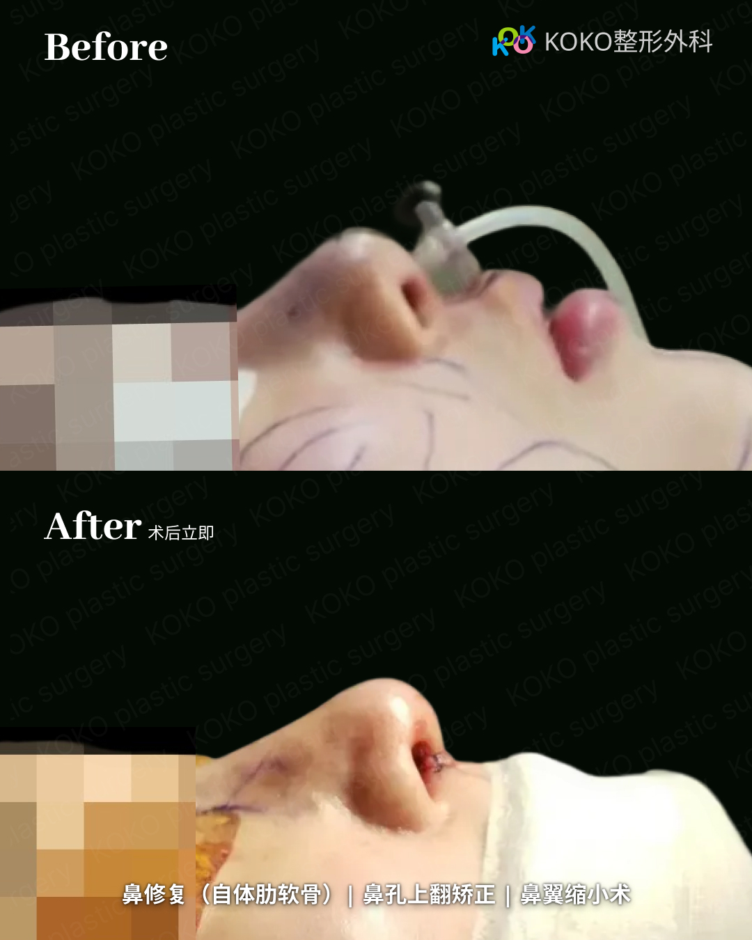 韩国鼻修复名医解析|自体肋软骨鼻修复与朝天鼻矫正(KOKO)| 鼻整形