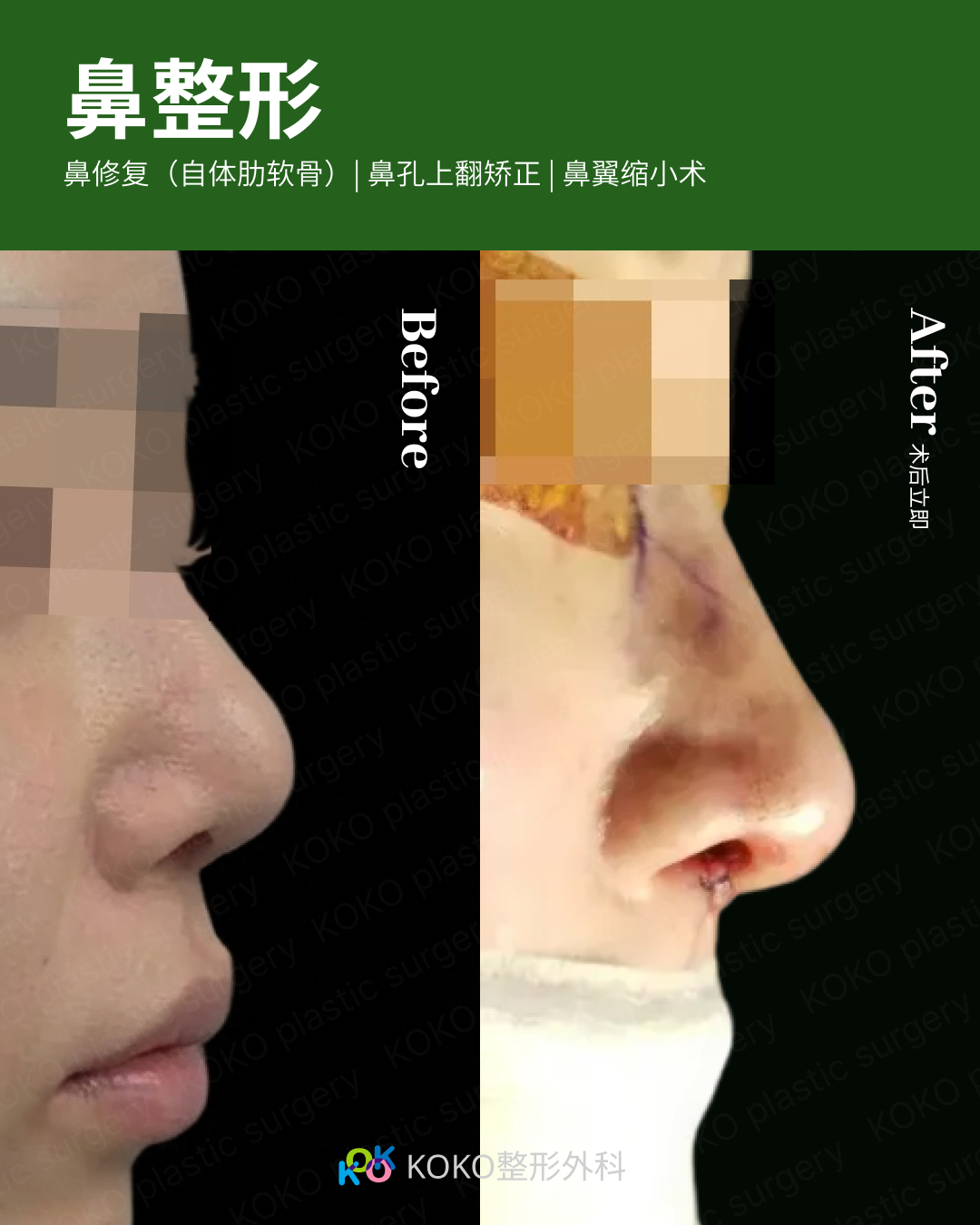 鼻整形手术前后的侧面对比。左侧“Before”显示鼻头圆钝且略微上翻。右侧“After”显示术后效果,通过自体肋软骨移植和鼻翼缩小术,鼻尖线条变得更加立体、精致,鼻唇角得到优化,整体轮廓更符合美学比例。