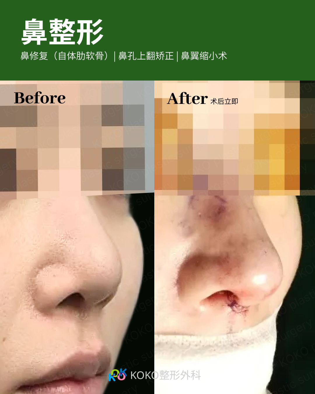 鼻部多项手术对比。左图“Before”显示鼻翼较宽,鼻孔上翻明显。右图“After”显示术后即刻状态,进行了鼻孔上翻矫正和鼻翼缩小。可以明显看到鼻翼变窄,鼻尖表现点更加清晰,伤口处有精细缝合,整体鼻型更加秀气。