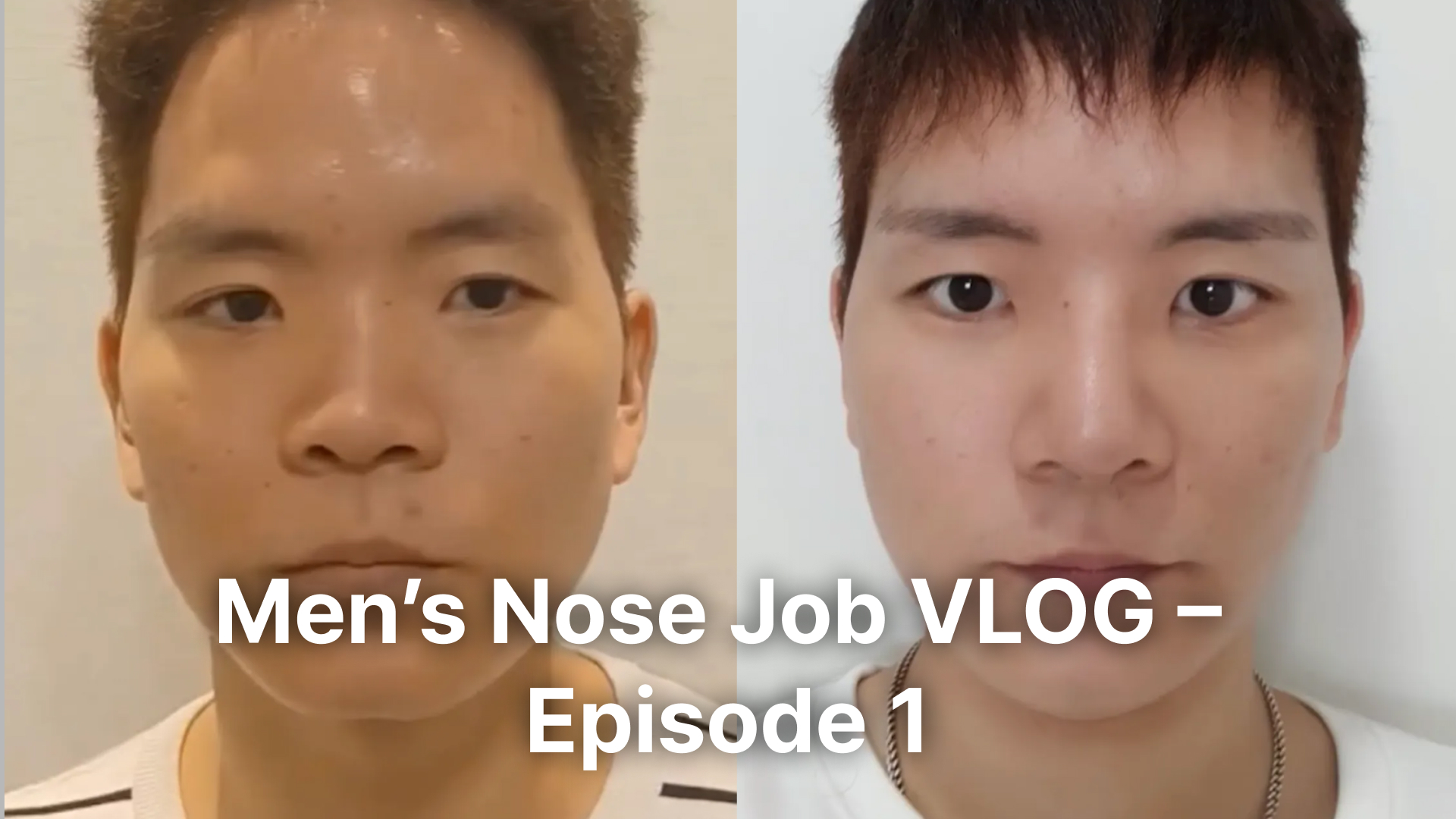 A video thumbnail showing a front-facing comparison of a male patient. The left side shows his nose before surgery (bulbous and wide), and the right side shows a slimmer, more defined nose bridge and tip after the procedure. The overlay text says "Men's Nose Job VLOG – Episode 1."