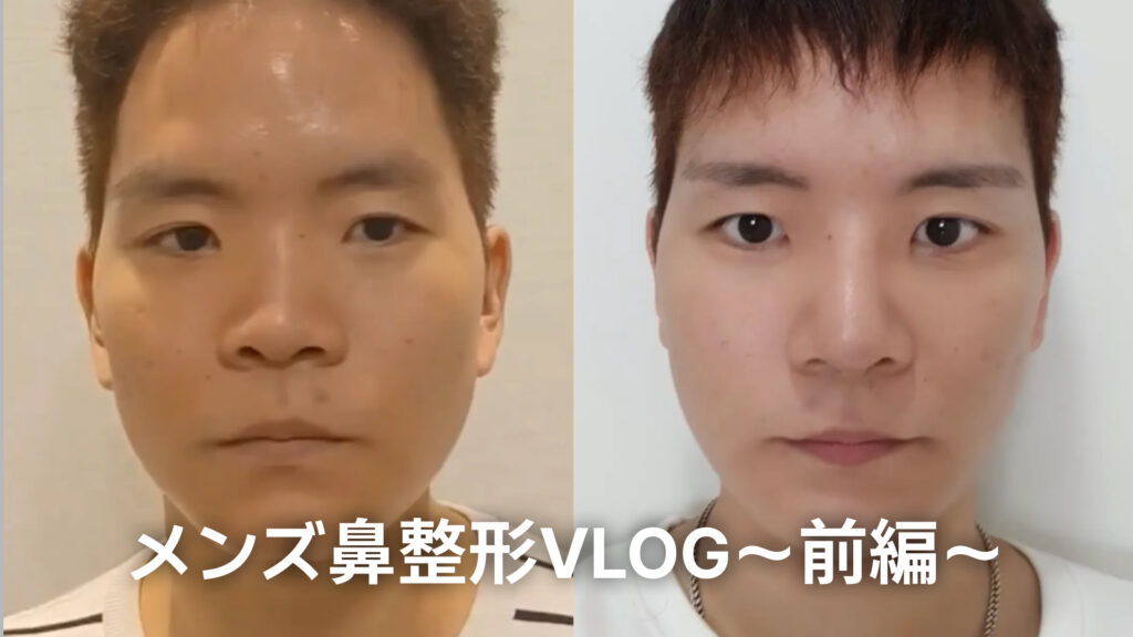 男性が鼻整形を受ける前と後の正面写真を並べた比較画像。左側は手術前、右側は手術後のスッキリとした鼻筋を強調しています。下部には「メンズ鼻整形VLOG〜前編〜」という白い文字のタイトルが記載されています。