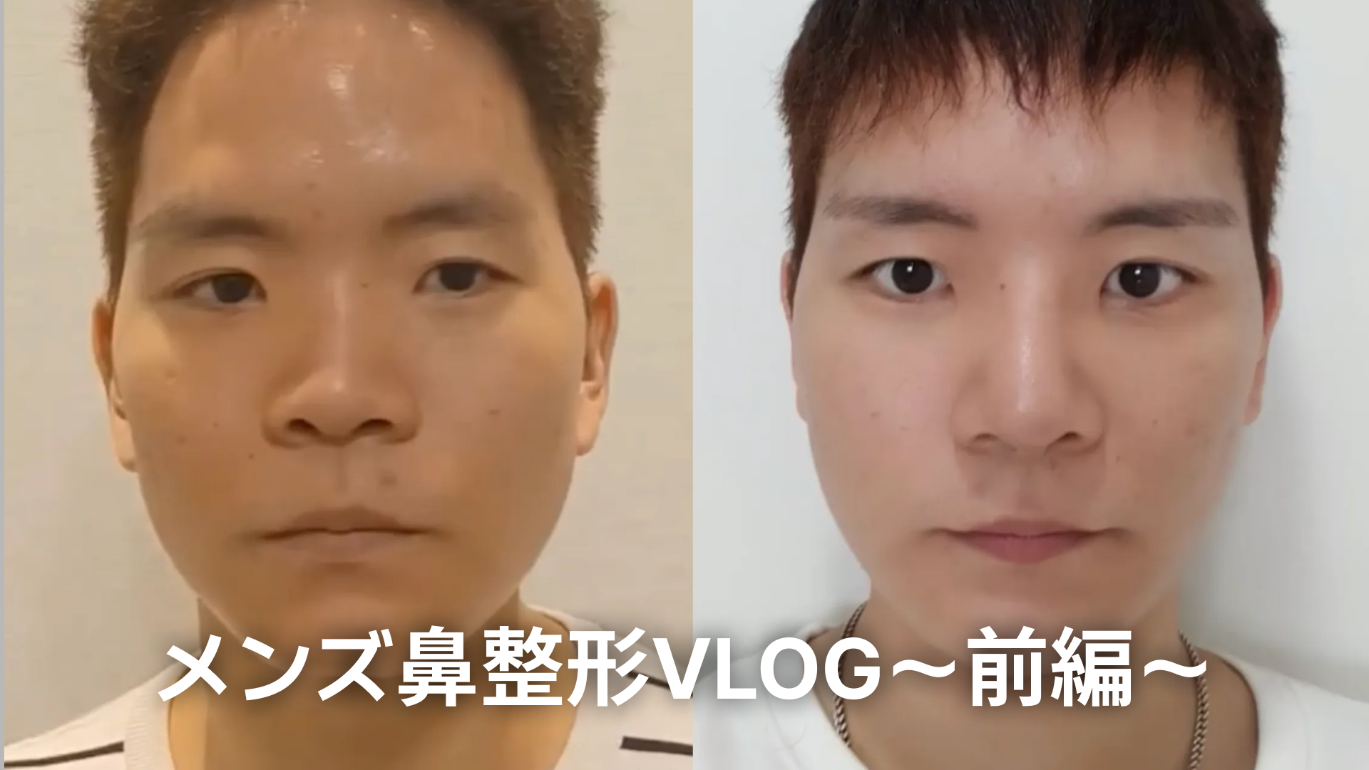 メンズ鼻整形Vlog|アップノーズ・豚鼻改善のリアル体験 | メンズ鼻整形