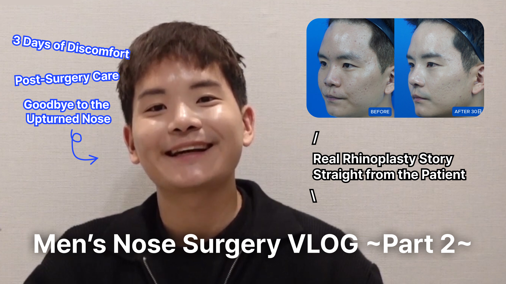 Here is the alternative text for the image in English, organized for clarity:  English Alternative Text (Alt Text)
A YouTube thumbnail for a men's rhinoplasty vlog featuring a personal surgery review.  Main Subject: A smiling young man in a black jacket is centered, looking directly at the camera.  Top Right (Comparison): A "Before" and "After 30 Days" side-by-side profile comparison showing the results of his nose surgery.  Text Overlays:  Main Title (Bottom): "Men’s Nose Surgery VLOG ~Part 2~"  Key Points (Top Left, Blue Text): "3 Days of Discomfort," "Post-Surgery Care," and "Goodbye to the Upturned Nose."  Review Note (Center Right): "Real Rhinoplasty Story Straight from the Patient."