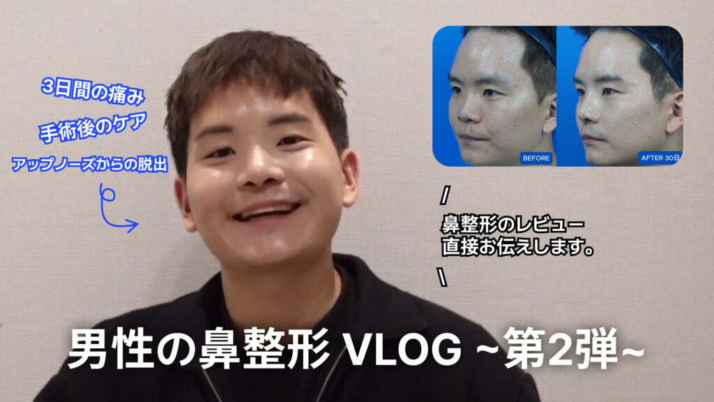 男性の鼻整形VLOG（ビデオブログ）のYouTubeサムネイル画像。 中央: 笑顔で話している若い男性の姿。 右上: 整形前（BEFORE）と30日後（AFTER 30日）の鼻の横顔を比較したビフォーアフター写真。 テキスト内容: 中央下部（大文字）: 「男性の鼻整形 VLOG ～第2弾～」 左上（青文字）: 「3日間の痛み」「手術後のケア」「アップノーズからの脱出」 中央右側: 「鼻整形のレビュー直接お伝えします。」