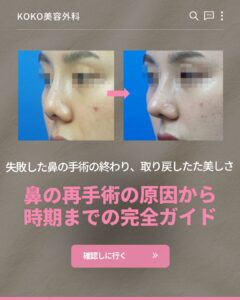 KOKO美容外科「鼻の再手術の原因から時期までの完全ガイド」の案内画像。女性の鼻のビフォーアフター写真とともに、「失敗した鼻の手術の終わり、取り戻した美しさ」というキャッチコピーと「確認しに行く」ボタンが配置されている。