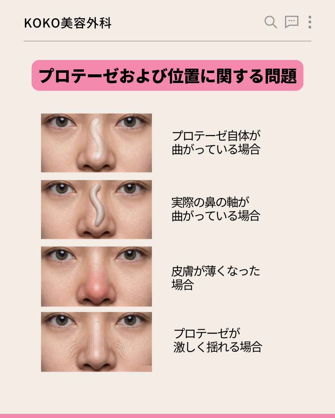 「プロテーゼおよび位置に関する問題」を説明する4つの症例写真。上から順に「プロテーゼ自体が曲がっている場合」「実際の鼻の軸が曲がっている場合」「皮膚が薄くなった場合」「プロテーゼが激しく揺れる場合」というテキストと、それぞれの状態を示す鼻のクローズアップ写真が並んでいる。