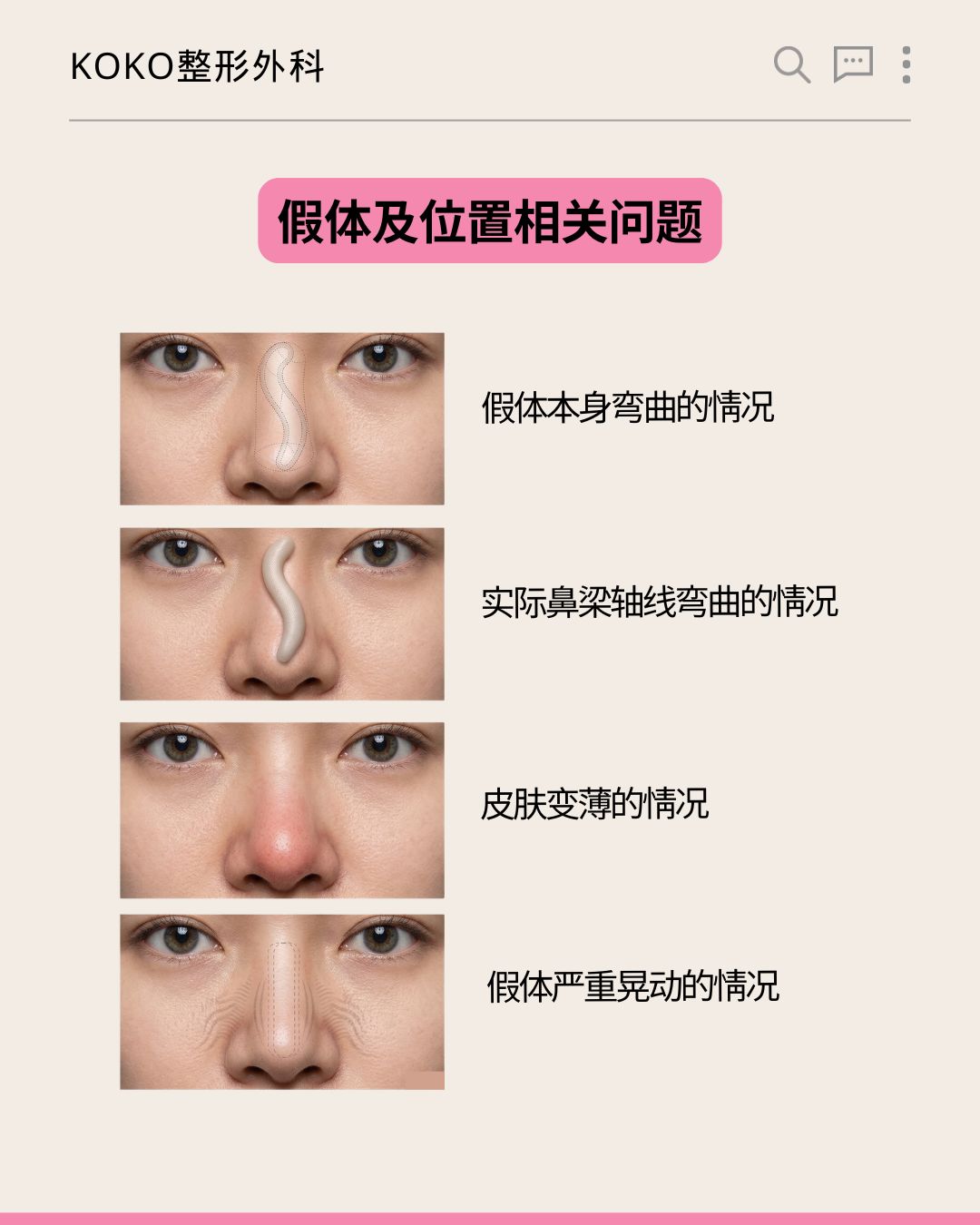 KOKO整形外科关于“假体及位置相关问题”的图解说明。从上到下展示了四种鼻部不良情况的配图与文字: 假体本身弯曲的情况:配有鼻部内假体呈弯曲状的透视示意图。 实际鼻梁轴线弯曲的情况:配有鼻梁呈S型弯曲的透视示意图。 皮肤变薄的情况:配有鼻尖皮肤泛红、变薄的实拍图。 假体严重晃动的情况:配有表示假体在鼻部内不稳定、晃动的示意图。