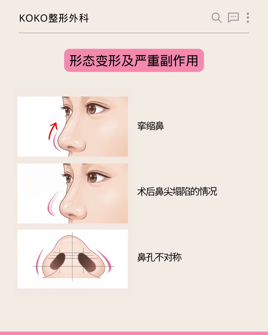 KOKO整形外科关于“形态变形及严重副作用”的图解说明。从上到下展示了三种鼻部严重副作用的插画与文字: 挛缩鼻:插画展示鼻尖向上挛缩、变短的情况。 术后鼻尖塌陷的情况:插画展示鼻尖下移、塌陷的情况。 鼻孔不对称:插画从仰视角度展示两侧鼻孔大小和形状不一致的情况。