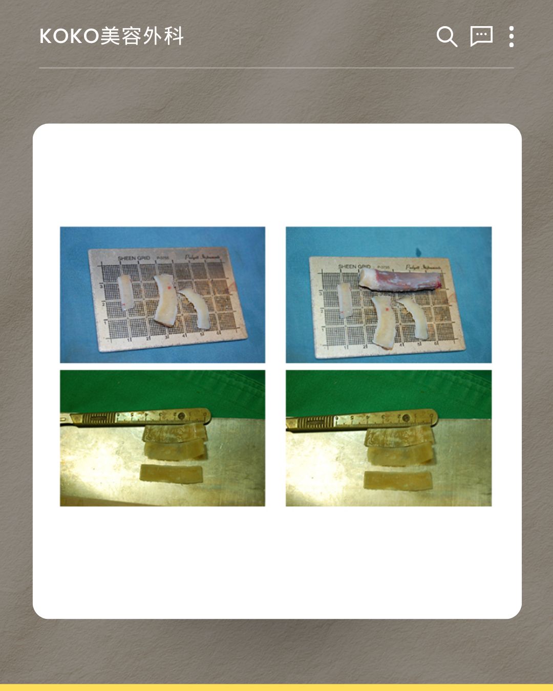 採取後に加工された自家肋軟骨を示す4枚の写真。医療用のグリッド付きプレートや定規の上に置かれており、鼻中隔再建のために適切な形とサイズに細かく整えられた複数の軟骨ピースが確認できる。