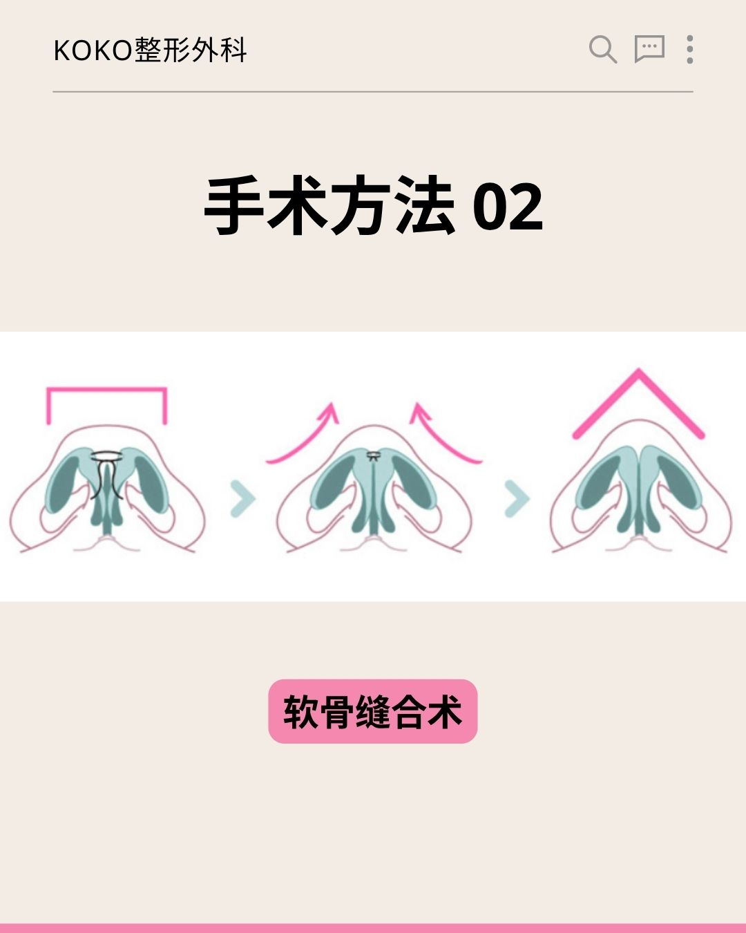 KOKO整形外科关于“手术方法 02”的图解说明。图片从仰视角度(鼻孔视角)展示了鼻部软骨的形态变化,通过三个阶段的示意图和粉色箭头,演示了将原本宽平、向两侧分散的鼻翼软骨向中间聚拢并缝合,从而使鼻尖变得尖挺的过程。最下方配有粉色底黑字的标签:“软骨缝合术”。