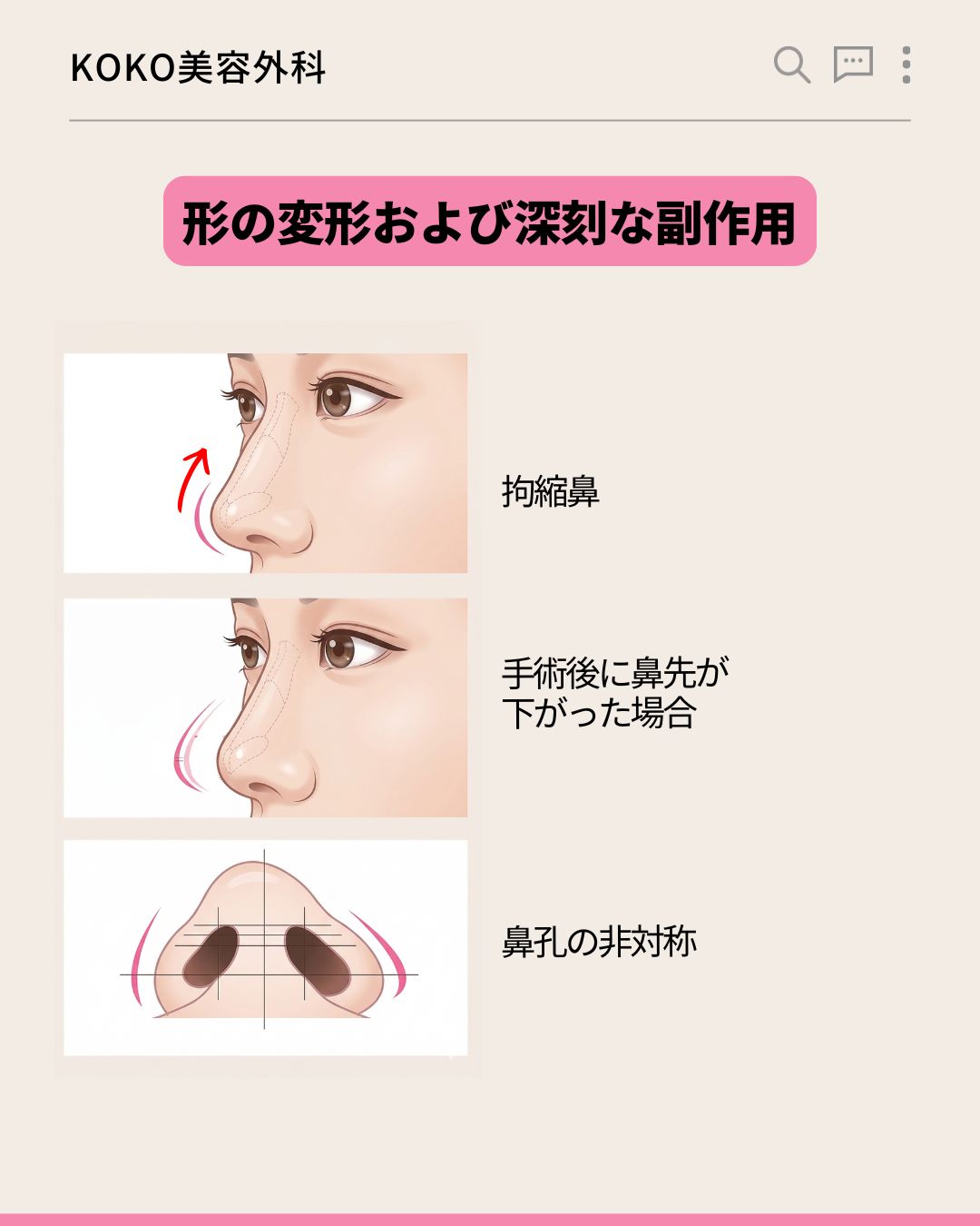 「形の変形および深刻な副作用」を説明する3つのイラスト。上から順に、鼻先が上を向いた「拘縮鼻」、鼻先が垂れ下がった「手術後に鼻先が下がった場合」、下から見た状態の「鼻孔の非対称」というテキストと、それぞれの状態を分かりやすく図解したイラストが並んでいる。