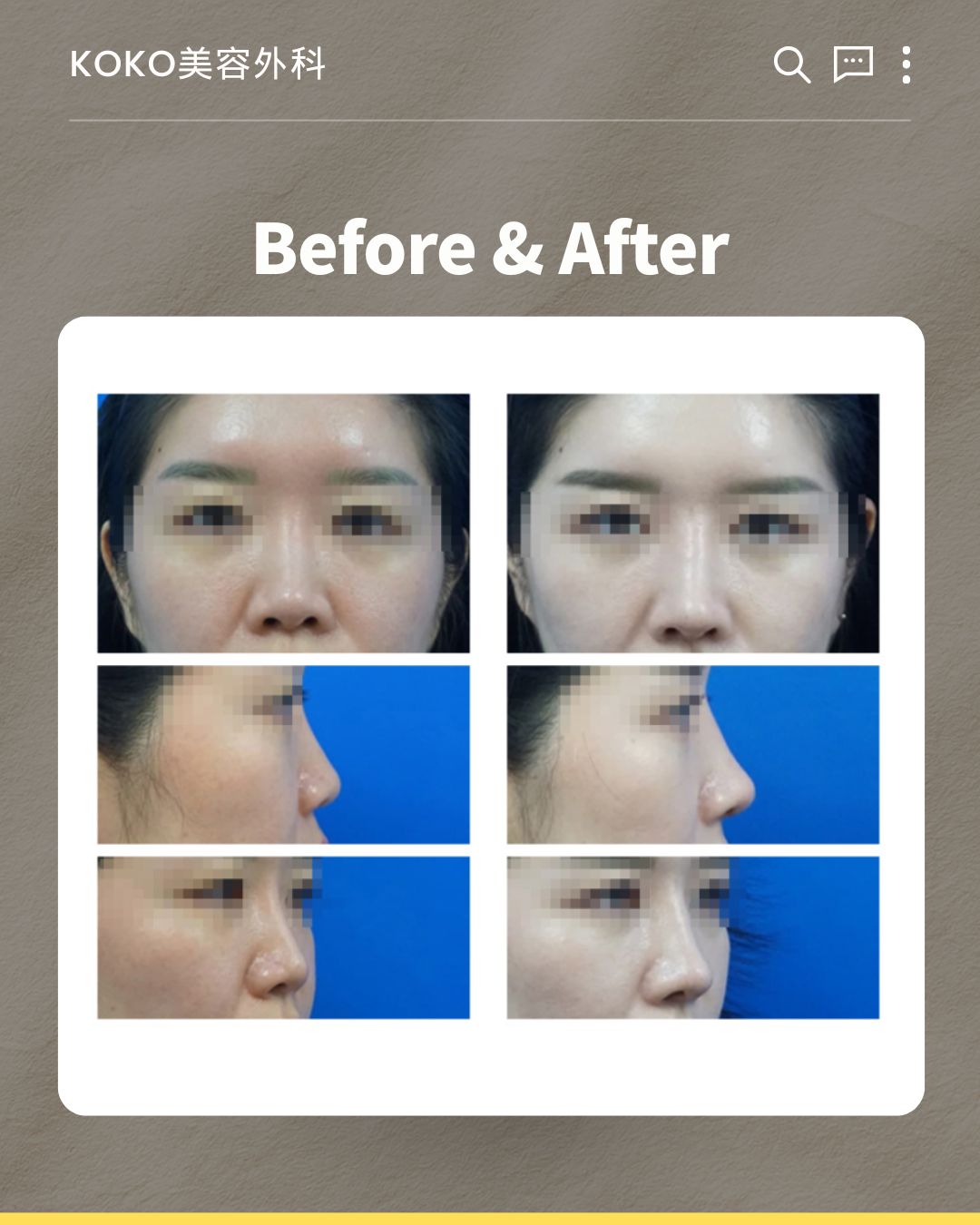 KOKO美容外科における自家肋軟骨鼻中隔再建術の「Before & After」画像。1名の患者の手術前(左)と手術後(右)の顔写真を比較したものが3段にわたって掲載されている。上から順に、正面、横顔、斜めからのアングルとなっており、患者の目元にはプライバシー保護のためのモザイク処理が施されている。