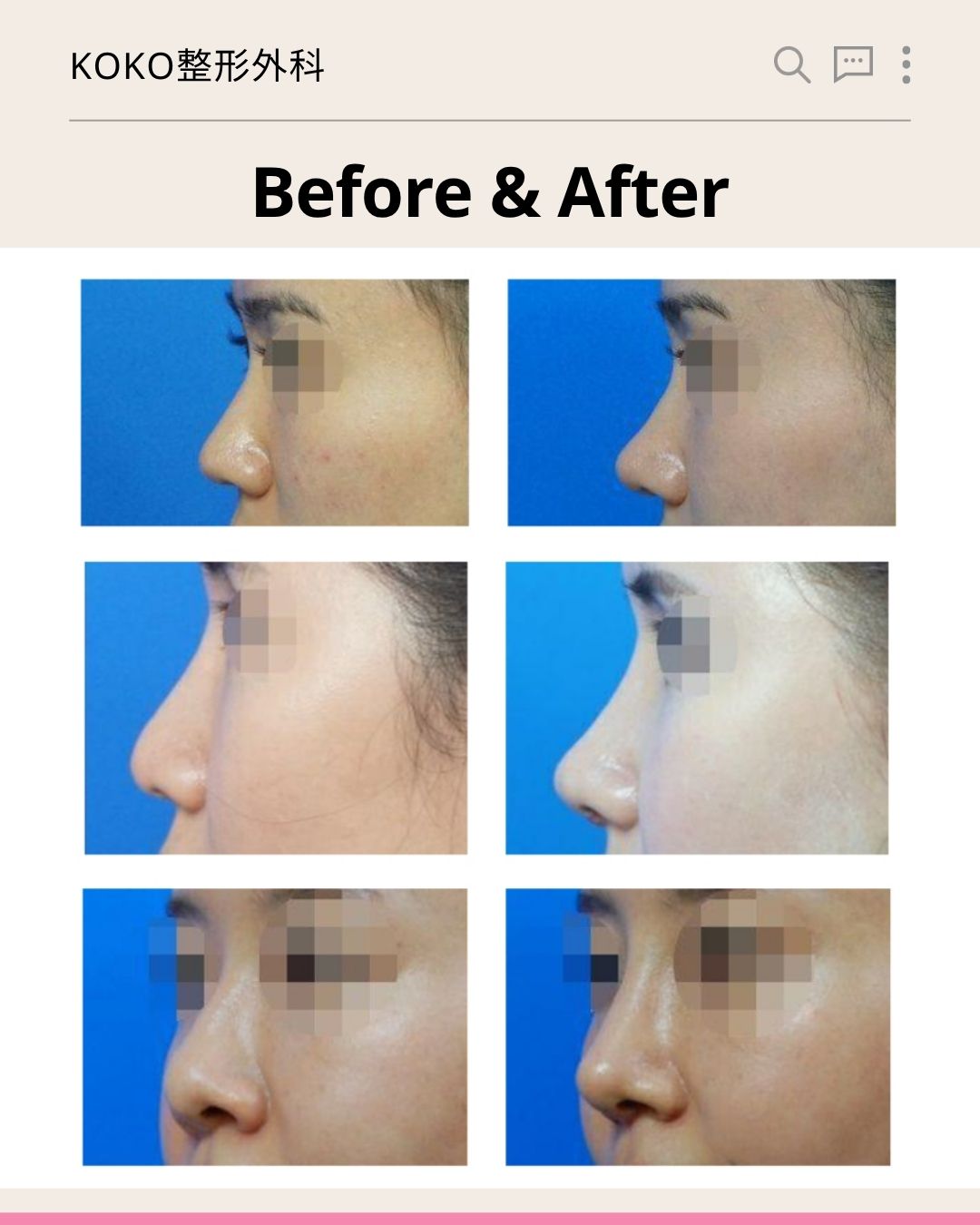 KOKO整形外科鼻尖整形的“Before & After”真实案例对比图。图片包含三组女性患者的鼻部整形前后侧脸或半侧脸对比照(左侧为术前,右侧为术后)。三组对比均明显展示了原本圆钝的鼻尖在术后变得更加精致、微翘且线条流畅的效果。所有患者的眼部均已做马赛克隐私处理。