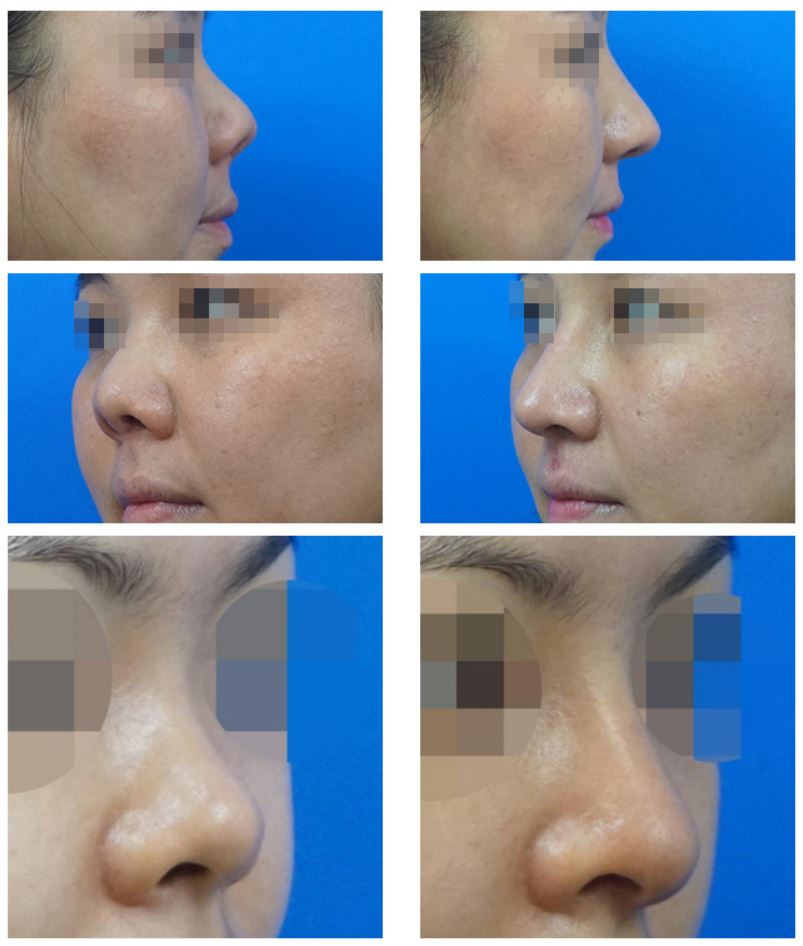 3名の患者のアップノーズ(豚鼻)矯正手術のビフォーアフター写真。左側が手術前、右側が手術後の写真で構成されており、上を向いていた鼻先が下がり、自然で美しい鼻のラインに改善されている様子が確認できます。