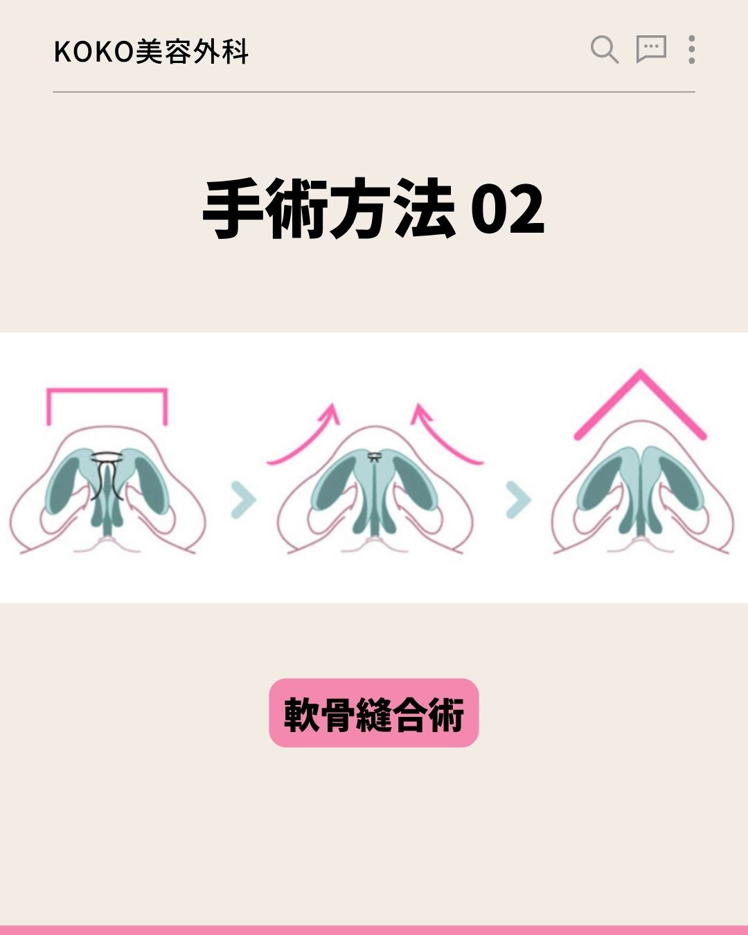 KOKO美容外科の「手術方法 02」を説明する画像。鼻の軟骨の正面(または下から見た)イラストが描かれています。広がった軟骨を中央に寄せて結び、鼻先を高くする過程が3段階のイラストと矢印で示されています。下部にはピンク色の背景で「軟骨縫合術」と書かれています。