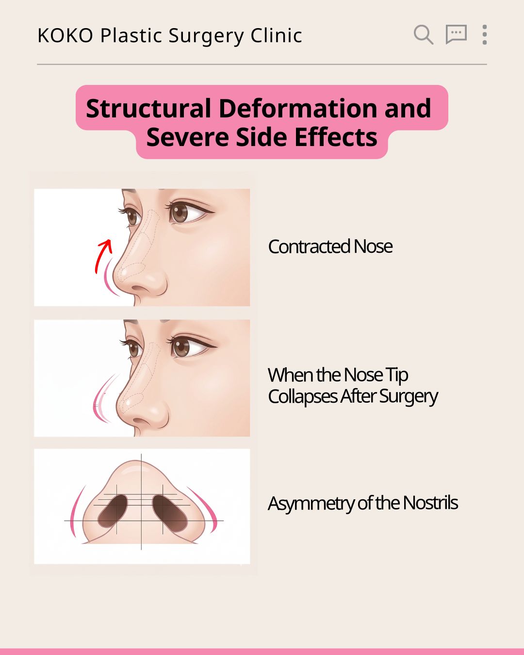 A "Before & After" photo collage from KOKO Plastic Surgery Clinic. It features three sets of side-profile photos of a female patient. The 'before' photos on the left show her original nose shape, while the 'after' photos on the right demonstrate a visibly raised, straightened, and refined nose bridge and tip following revision rhinoplasty. The patient's eyes are pixelated for privacy.