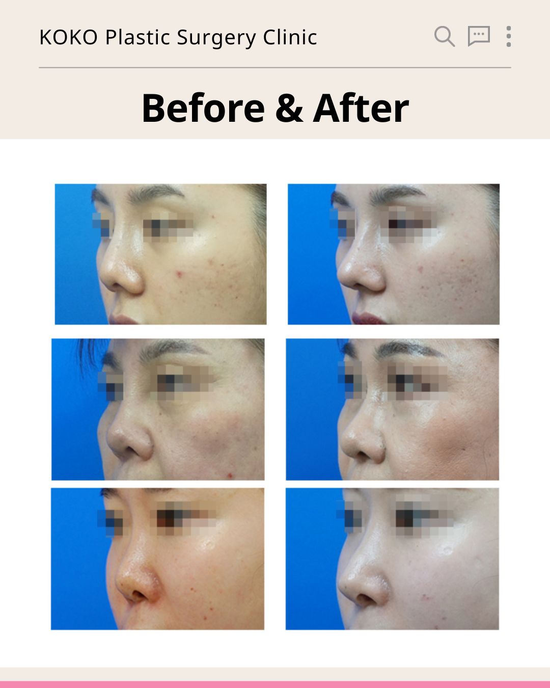 A promotional cover image for KOKO Plastic Surgery Clinic. The top section displays a before-and-after side profile photo of a woman's nose, with a pink arrow pointing to the improved post-surgery result. Below the image, white text reads, "The End of Failed Nose Surgeries, Rediscover Your Beauty," followed by a large pink headline stating, "A Complete Guide from Causes to Timing of Revision Rhinoplasty." At the bottom is a pink button that says, "Check it out now >>".