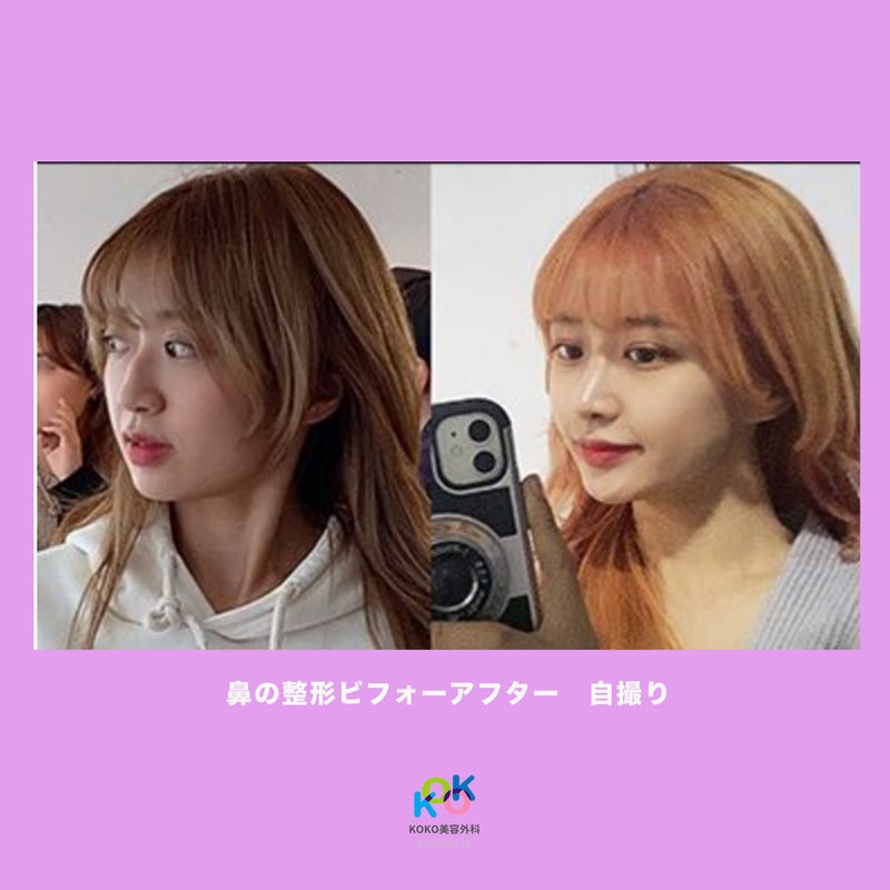 鼻の整形ビフォーアフター 自撮り