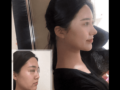 当院で鼻整形と顔面脂肪  移植を受けた患者さんの  最近の自撮り写真です。